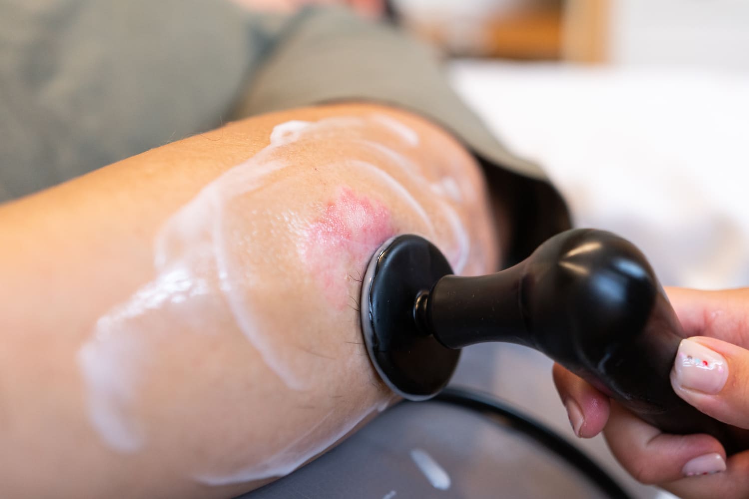 DIATERMIA TRACTAMENT PSORIASIS